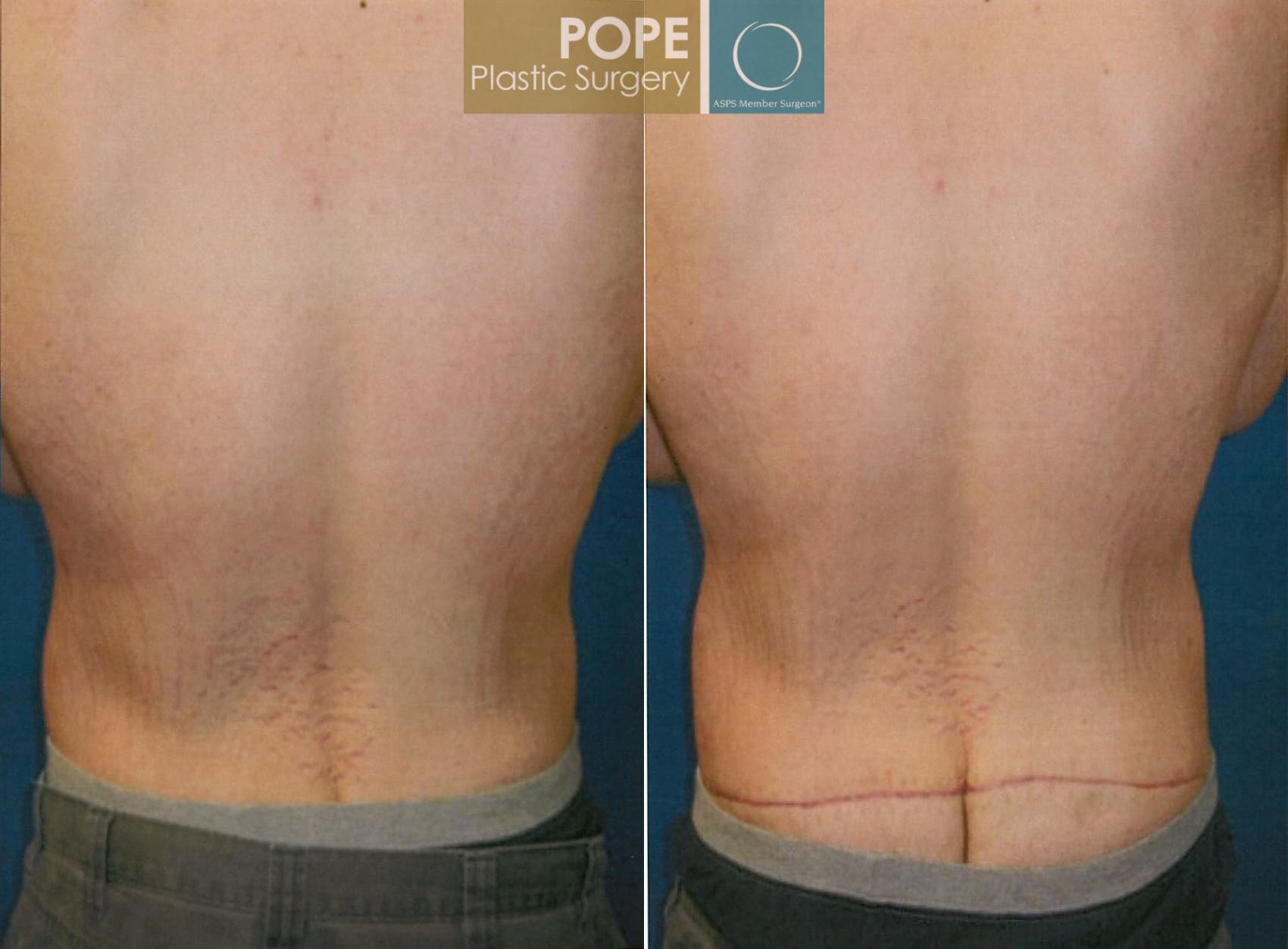 Before & After Body Lift Case 183 View #1 View in Orlando, FL
