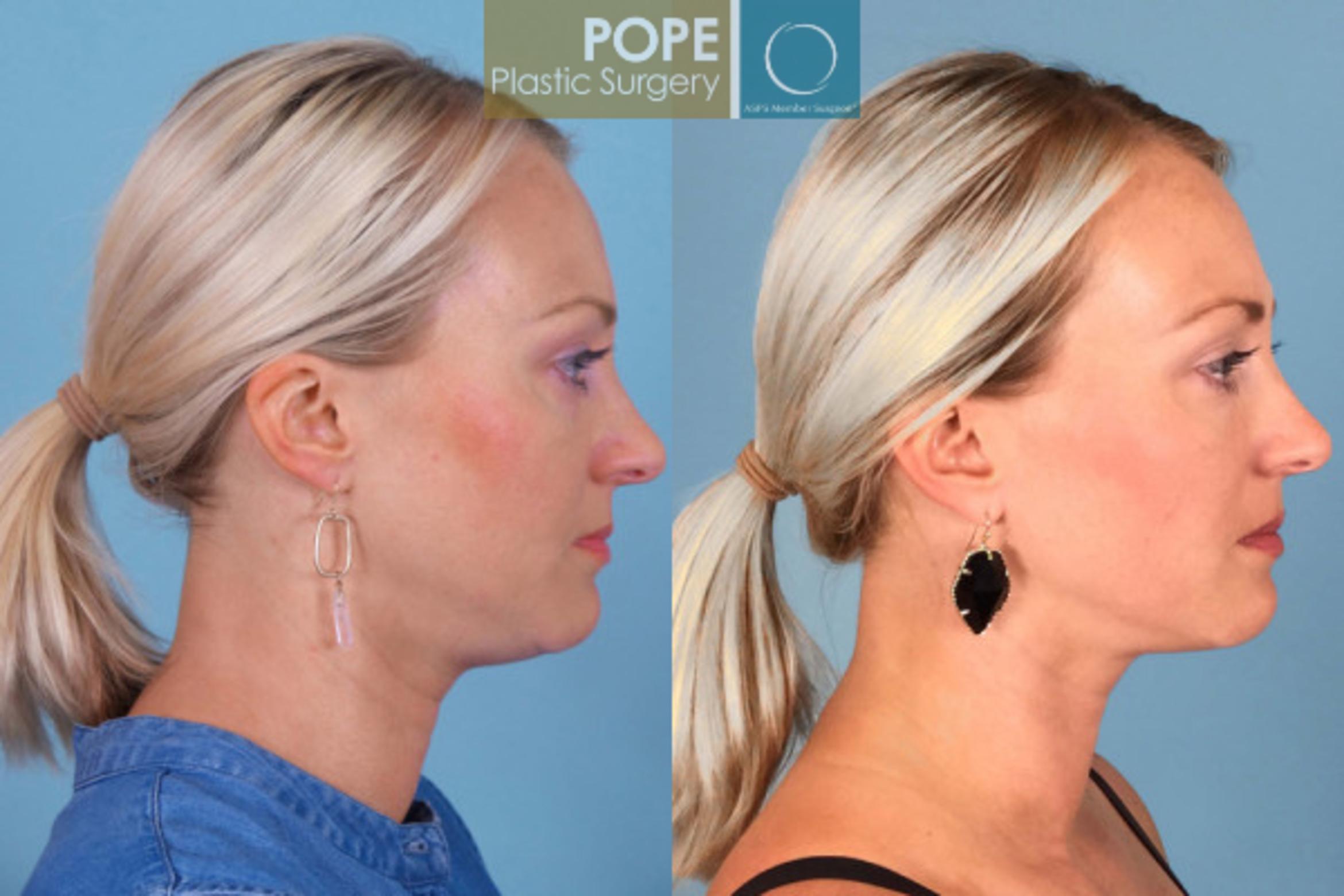 KYBELLA® Case 62 Before & After View #1 | Orlando, FL | Pope Plastic Surgery