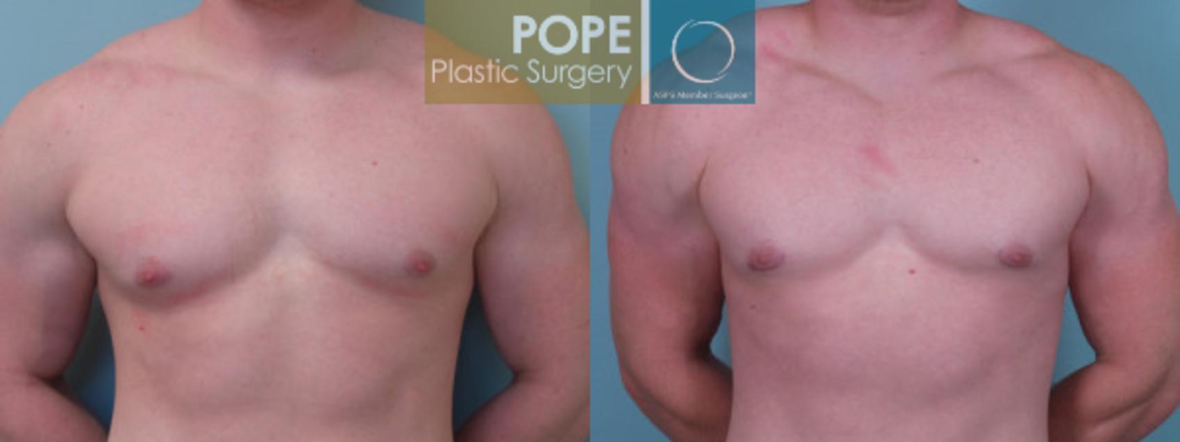 Before & After Male Breast Reduction Case 52 View #1 View in Orlando, FL