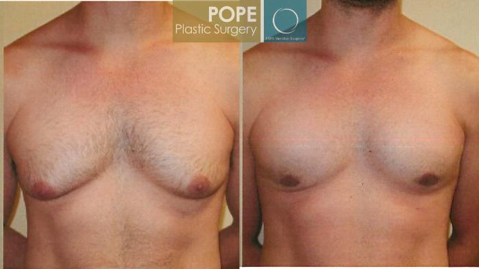 Before & After Male Breast Reduction Case 95 View #1 View in Orlando, FL