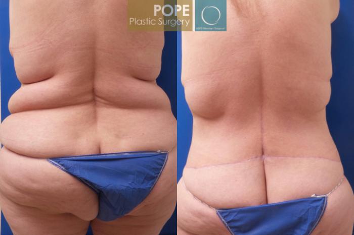 Before & After Body Lift Case 195 Back View in Orlando, FL