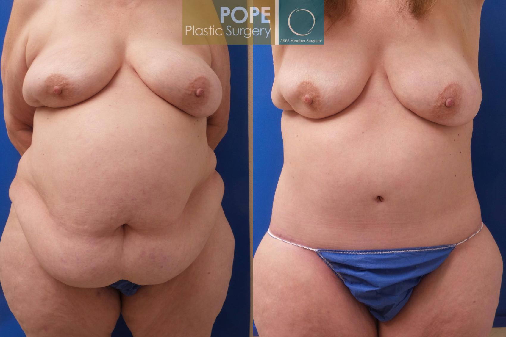Before & After Body Lift Case 195 Front View in Orlando, FL