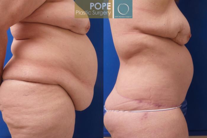 Before & After Body Lift Case 195 Right Side View in Orlando, FL