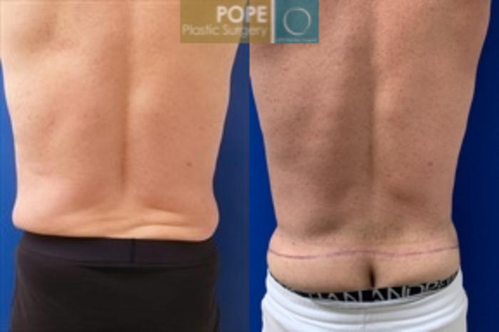 Before & After Body Lift Case 198 Back Flanks View in Orlando, FL