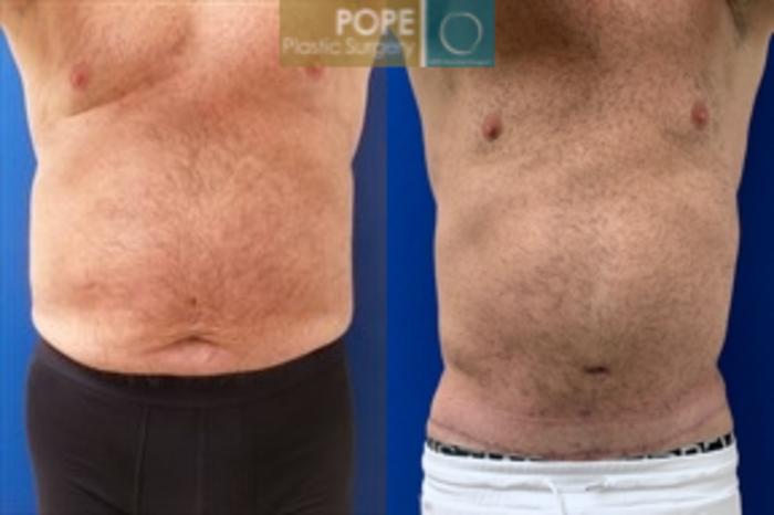 Before & After Body Lift Case 198 Front Abdomen View in Orlando, FL