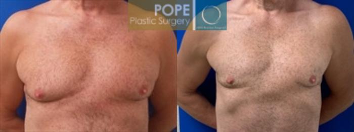 55-year-old man, before liposuction of chest