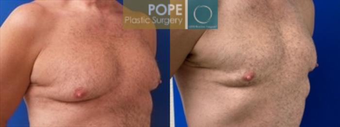 Before & After Body Lift Case 198 Left Oblique Chest View in Orlando, FL