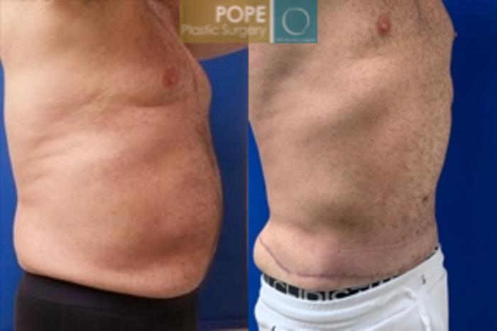 Before & After Body Lift Case 198 Left Oblique View in Orlando, FL