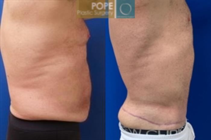 Before & After Body Lift Case 198 Left Side View in Orlando, FL