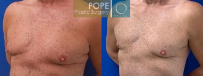 Before & After Body Lift Case 198 Right Oblique Chest View in Orlando, FL
