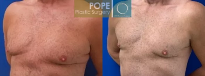 Body Lift Before and After Pictures Case 198, Orlando, FL