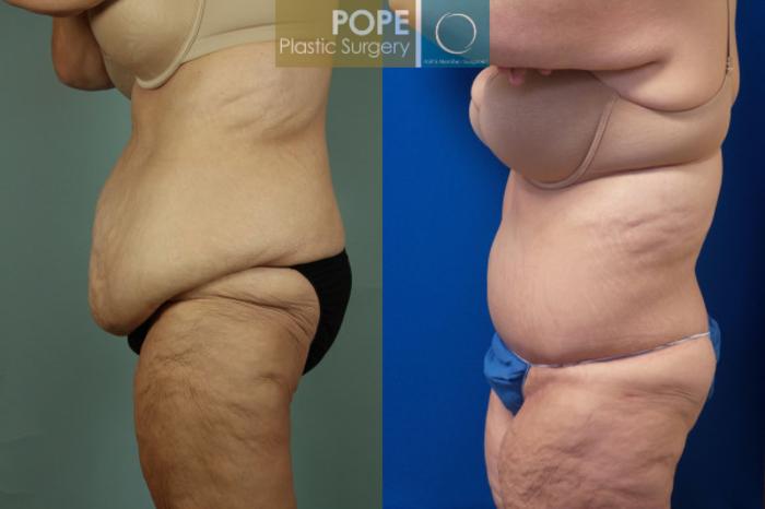 Before & After Body Lift Case 60 View #2 View in Orlando, FL
