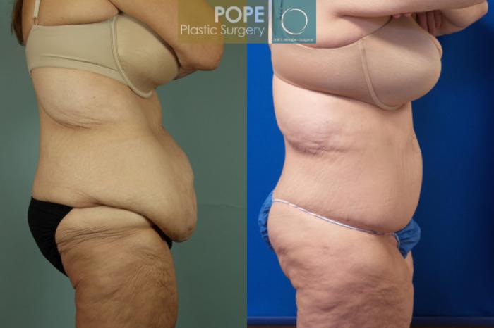 Before & After Body Lift Case 60 View #3 View in Orlando, FL