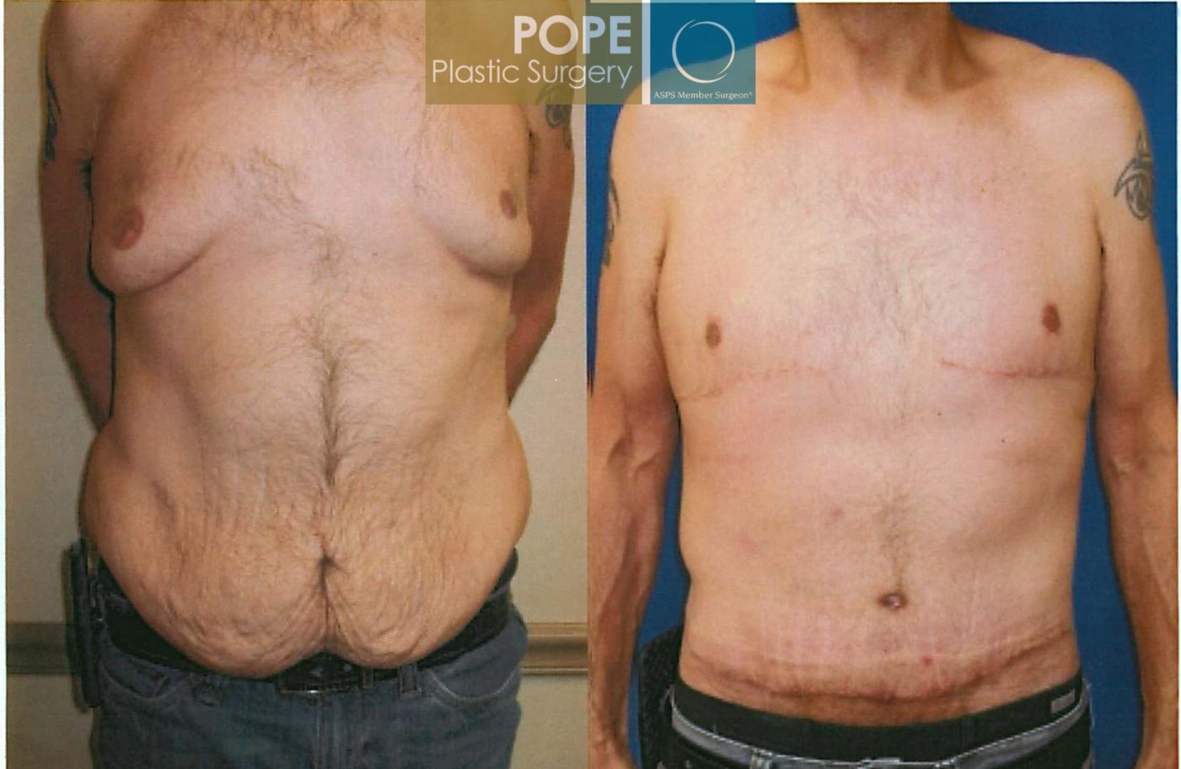 Body Lift Before and After Pictures Case 93, Orlando, FL