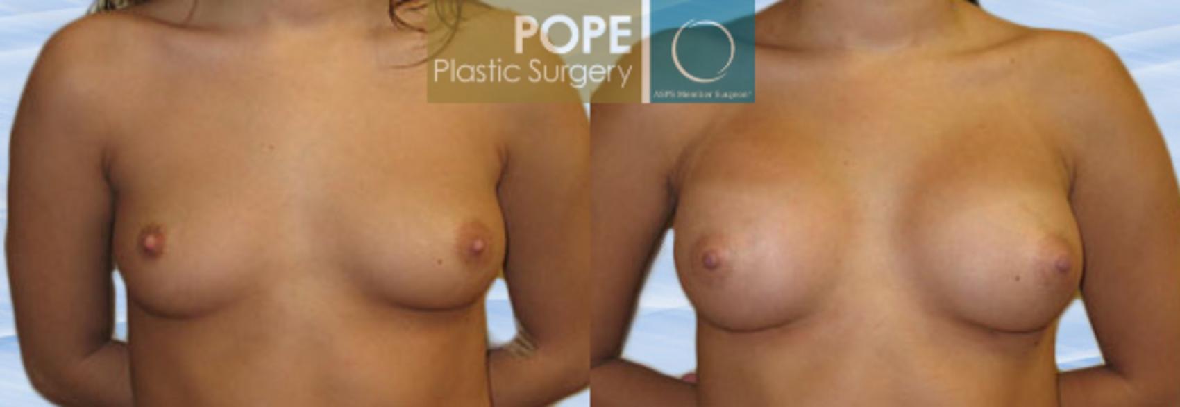 Before & After Breast Augmentation Case 109 View #1 View in Orlando, FL