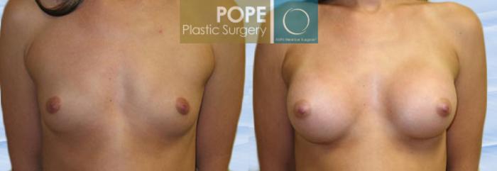 Before & After Breast Augmentation Case 110 View #1 View in Orlando, FL