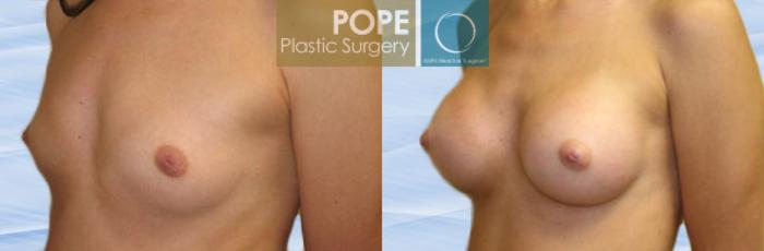Before & After Breast Augmentation Case 110 View #2 View in Orlando, FL