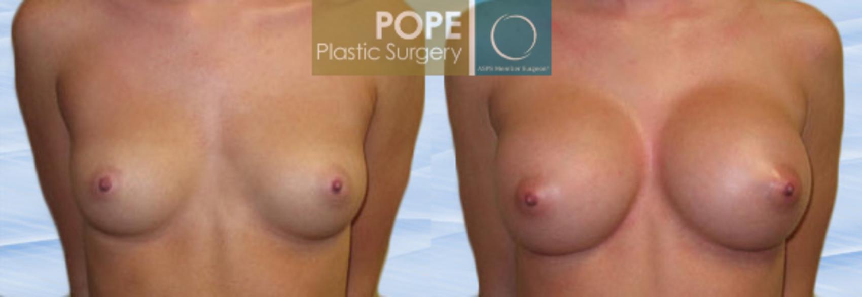 Before & After Breast Augmentation Case 111 View #1 View in Orlando, FL