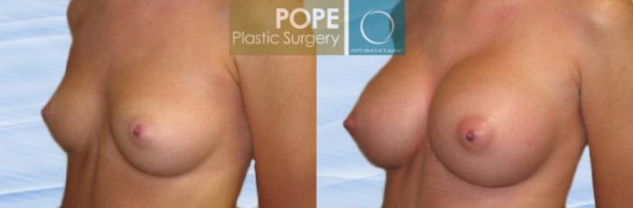 Before & After Breast Augmentation Case 111 View #2 View in Orlando, FL