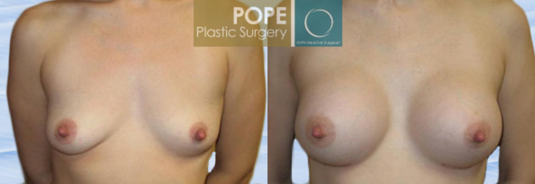 Before & After Breast Augmentation Case 112 View #1 View in Orlando, FL