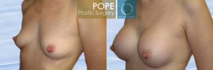 Before & After Breast Augmentation Case 112 View #2 View in Orlando, FL