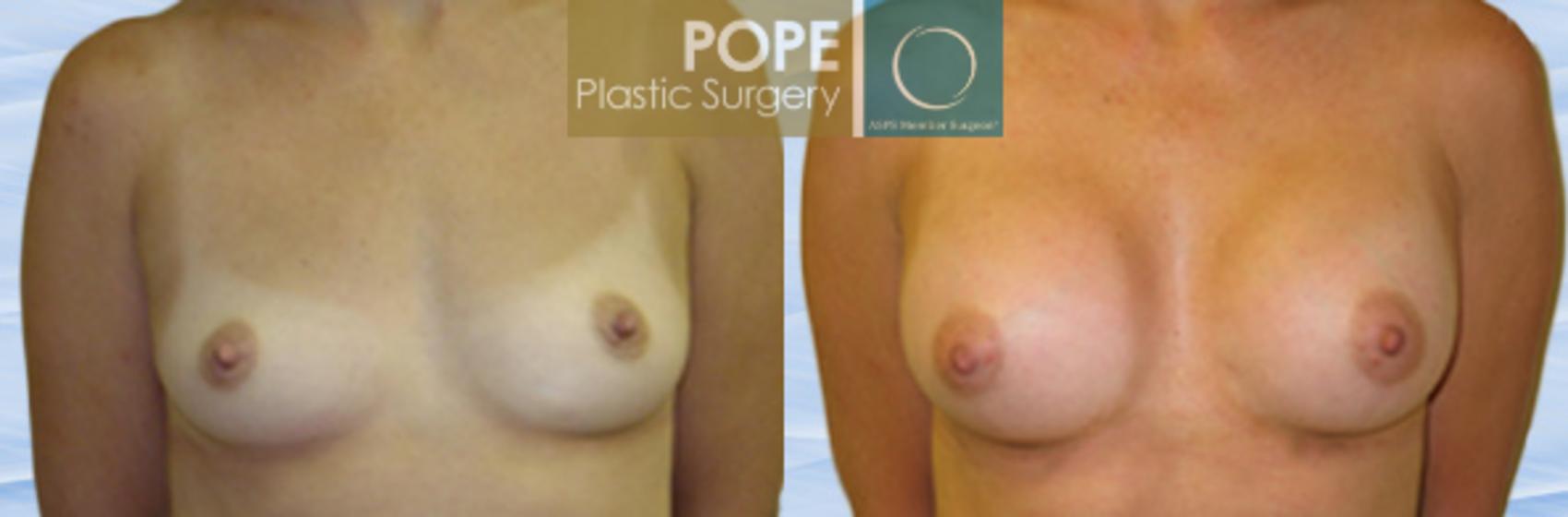 Before & After Breast Augmentation Case 113 View #1 View in Orlando, FL