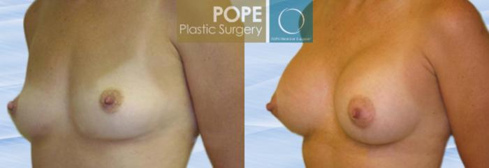 Before & After Breast Augmentation Case 113 View #2 View in Orlando, FL