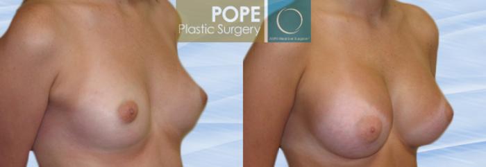 Before & After Breast Augmentation Case 114 View #2 View in Orlando, FL