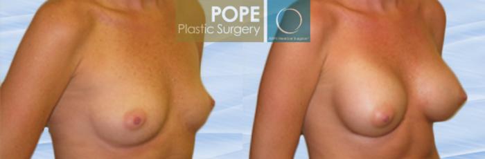 Before & After Breast Augmentation Case 115 View #2 View in Orlando, FL