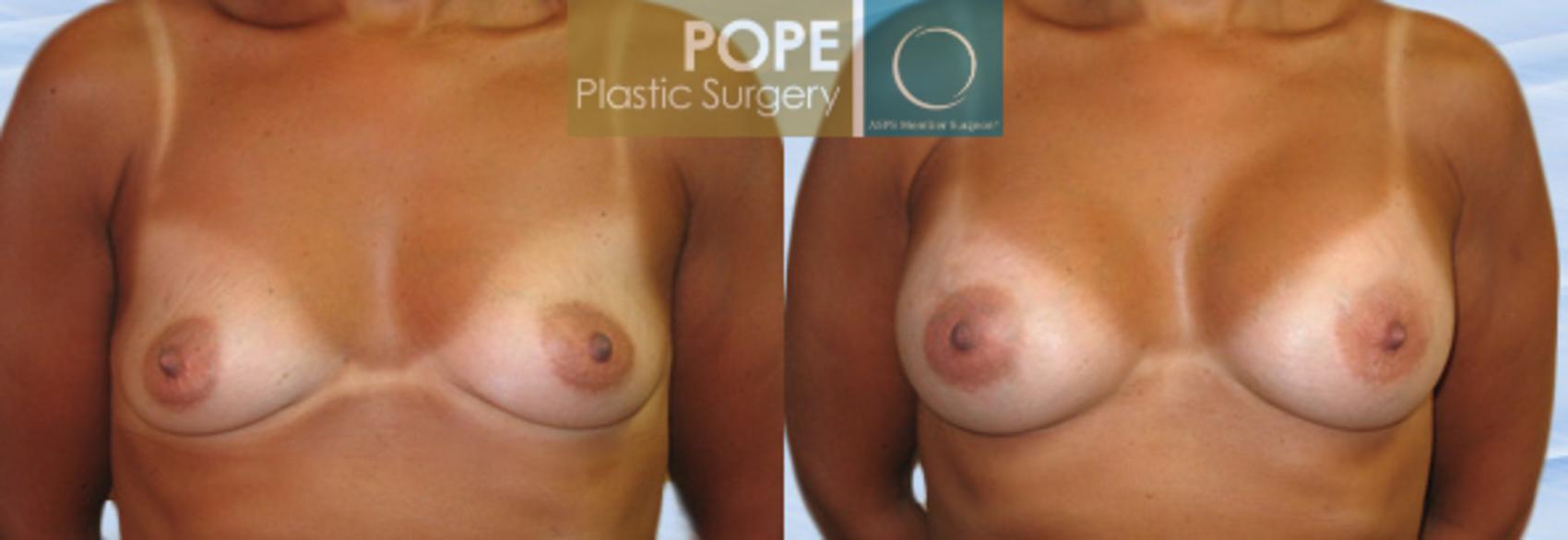 Before & After Breast Augmentation Case 116 View #1 View in Orlando, FL