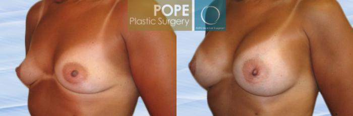 Before & After Breast Augmentation Case 116 View #2 View in Orlando, FL