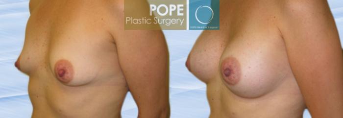 Before & After Breast Augmentation Case 117 View #2 View in Orlando, FL