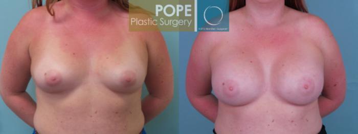 Before & After Breast Augmentation Case 118 View #1 View in Orlando, FL