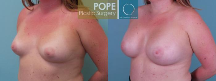 Before & After Breast Augmentation Case 118 View #2 View in Orlando, FL