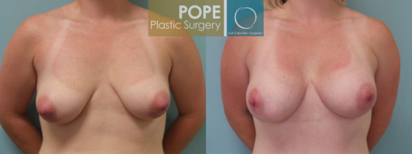 Before & After Breast Augmentation Case 119 View #1 View in Orlando, FL