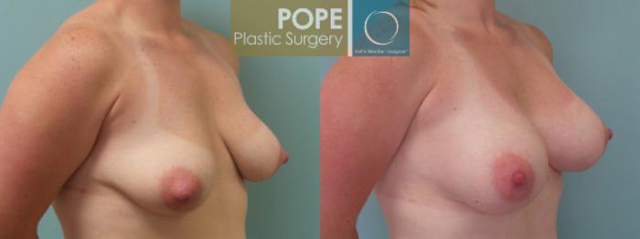 Before & After Breast Augmentation Case 119 View #2 View in Orlando, FL