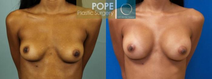 Before & After Breast Augmentation Case 120 View #1 View in Orlando, FL