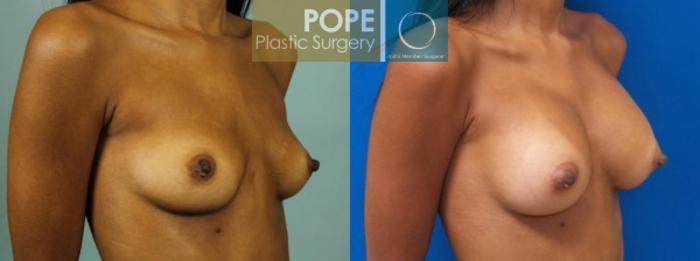 Before & After Breast Augmentation Case 120 View #2 View in Orlando, FL