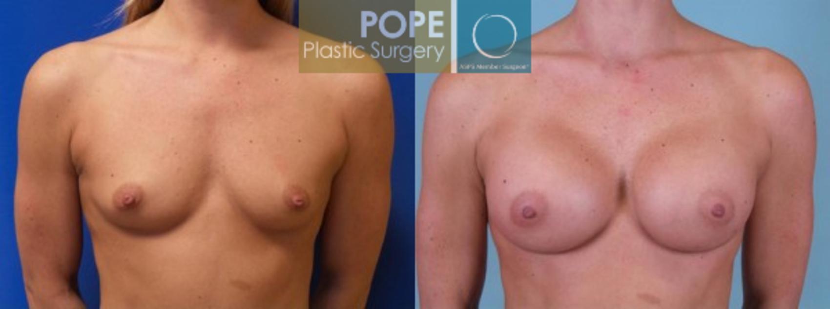 Before & After Breast Augmentation Case 121 View #1 View in Orlando, FL