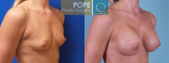 Before & After Breast Augmentation Case 121 View #2 View in Orlando, FL