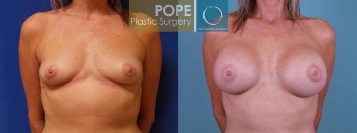 Before & After Breast Augmentation Case 122 View #1 View in Orlando, FL