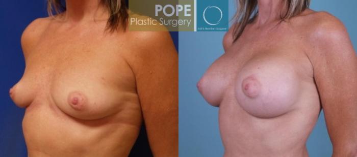 Before & After Breast Augmentation Case 122 View #2 View in Orlando, FL