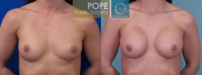 Before & After Breast Augmentation Case 123 View #1 View in Orlando, FL
