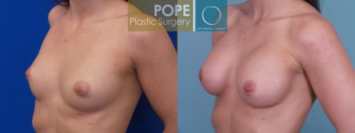 Before & After Breast Augmentation Case 123 View #2 View in Orlando, FL