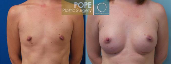Before & After Breast Augmentation Case 124 View #1 View in Orlando, FL