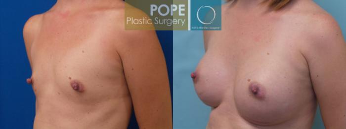Before & After Breast Augmentation Case 124 View #2 View in Orlando, FL