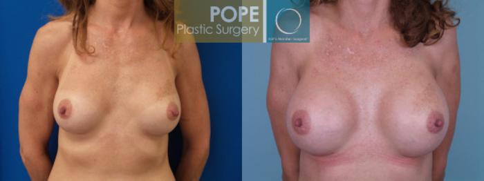 Before & After Breast Augmentation Case 125 View #1 View in Orlando, FL