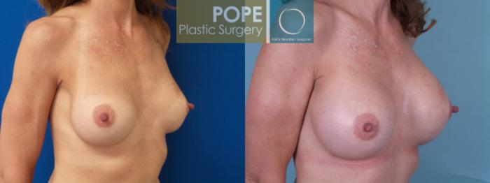 Before & After Breast Augmentation Case 125 View #2 View in Orlando, FL