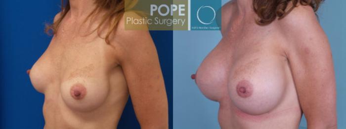 Before & After Breast Augmentation Case 125 View #3 View in Orlando, FL