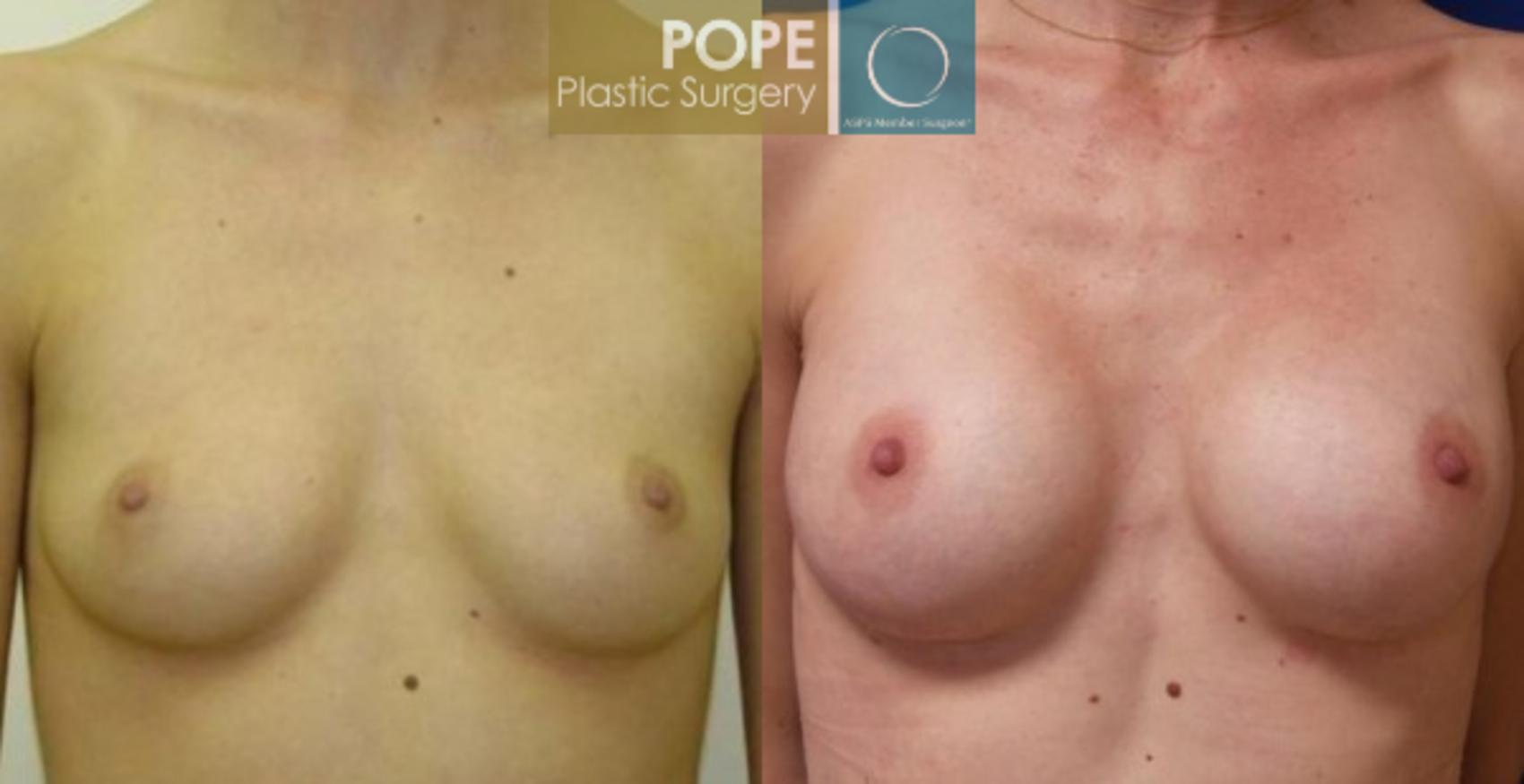 Before & After Breast Augmentation Case 126 View #1 View in Orlando, FL